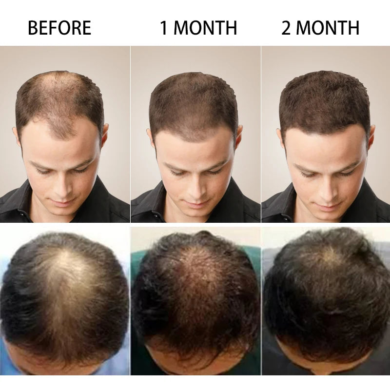 Purc hair density growth products prevent hair loss oil for Men Women