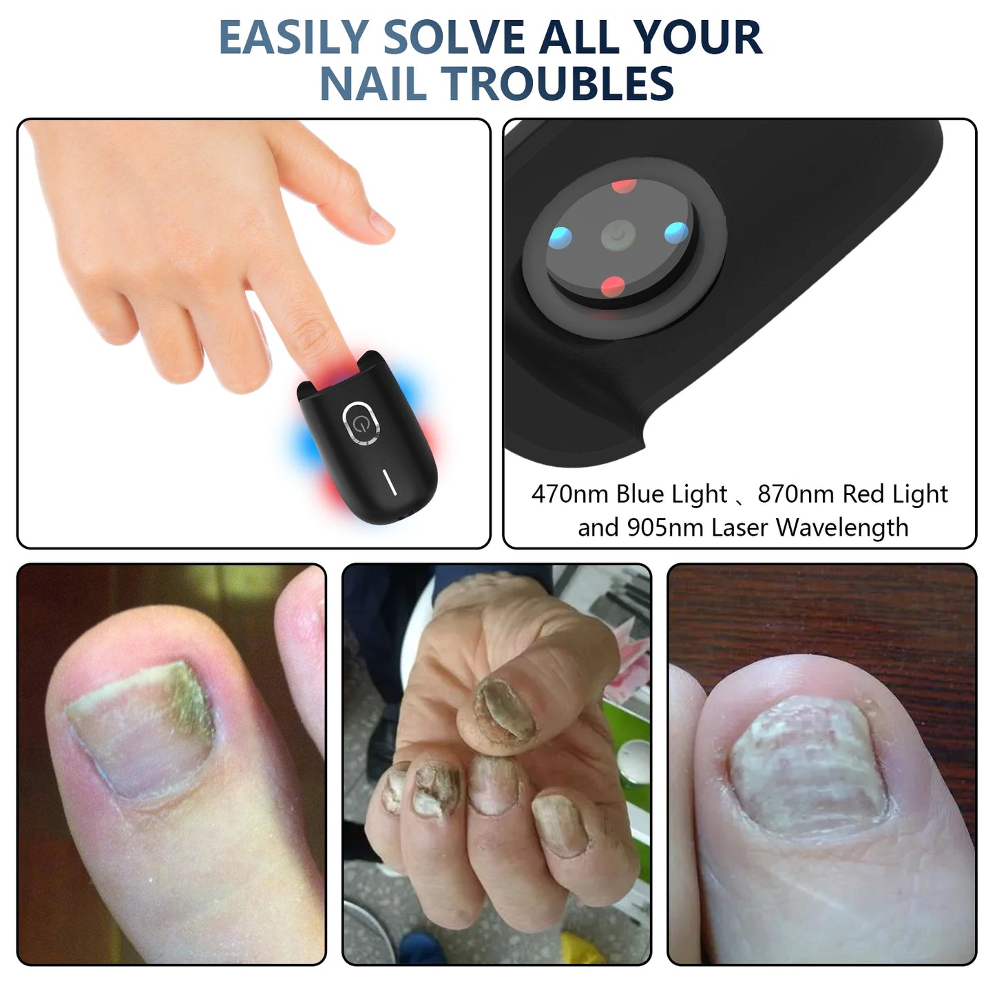 Nail Fungus Laser Device - Toenail Laser Therapy Machine, Anti-Fungal Equipment for Onychomycosis, 910nm & 407nm, USB Charge