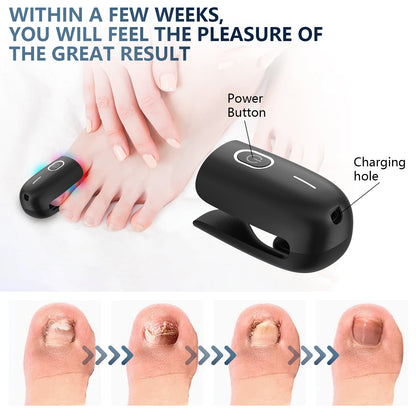 Nail Fungus Laser Device - Toenail Laser Therapy Machine, Anti-Fungal Equipment for Onychomycosis, 910nm & 407nm, USB Charge