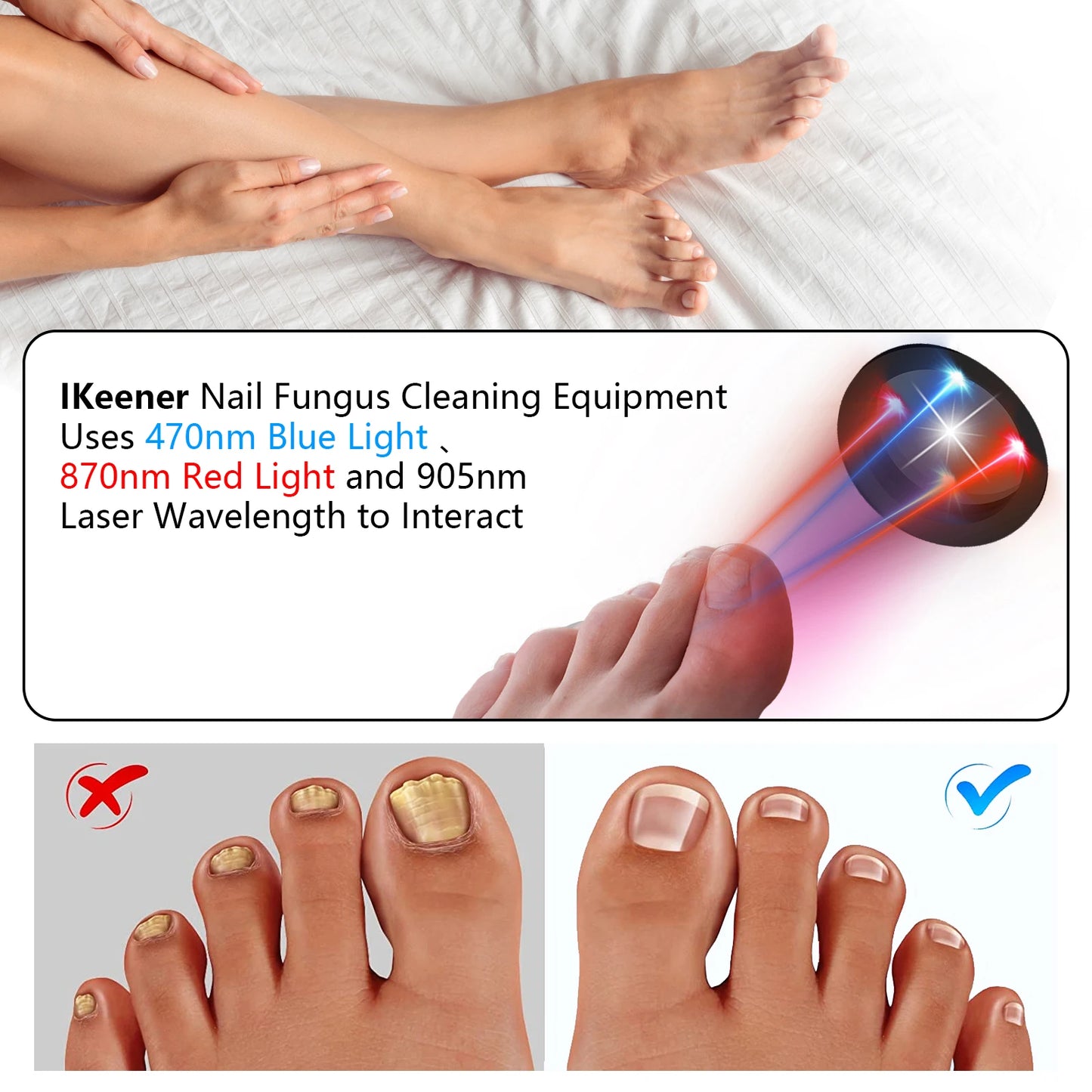 Nail Fungus Laser Device - Toenail Laser Therapy Machine, Anti-Fungal Equipment for Onychomycosis, 910nm & 407nm, USB Charge